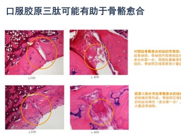Collameta胶原三肽：对骨愈合过程的影响怎么样？